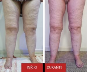 Lipedema membro inferior (ambas as pernas)
