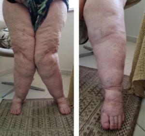 Lipedema em idoso (membros inferiores)