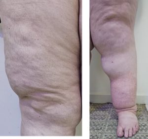 Lipedema em membro inferior