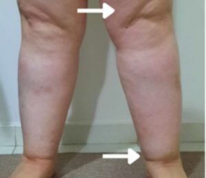 Lipedema em membro inferior