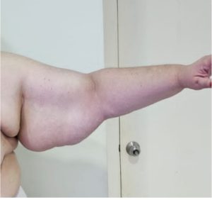 Lipedema em membro superiror