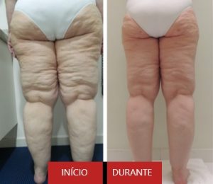 Tratamento de Lipedema